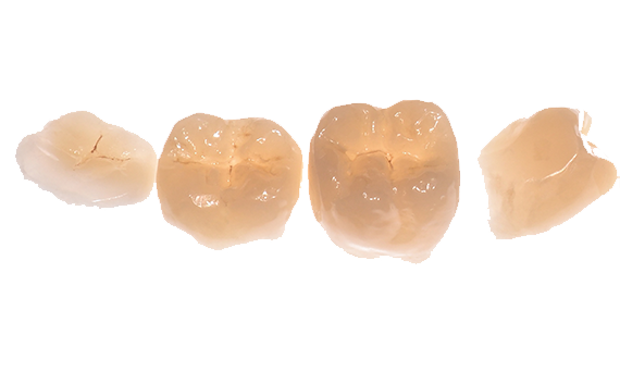 Image showing 4 units of indirect restorations made with Celtra Press