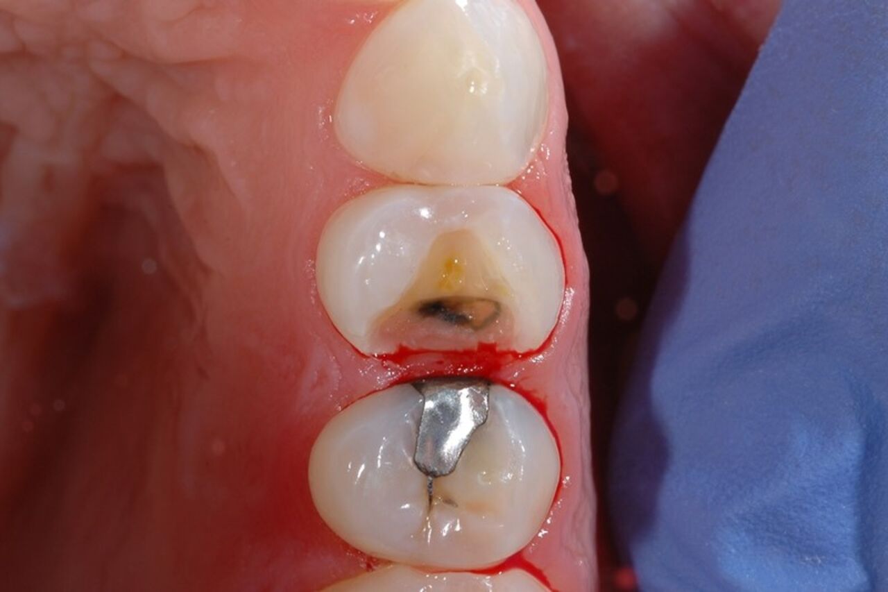 Isolation with wooden wedge which can often result in trauma and bleeding