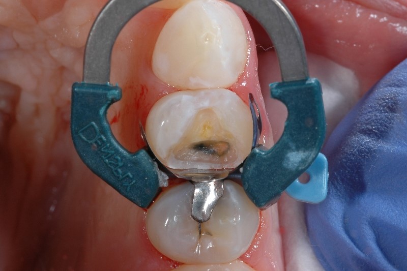 Isolation with Palodent Plus sectional matrix system wedge