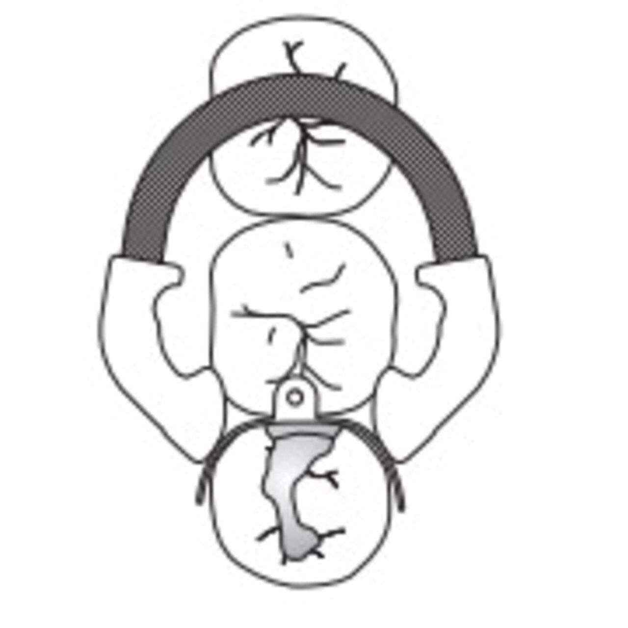 Palodent V3 / Plus - Use Case Distal-Occlusal