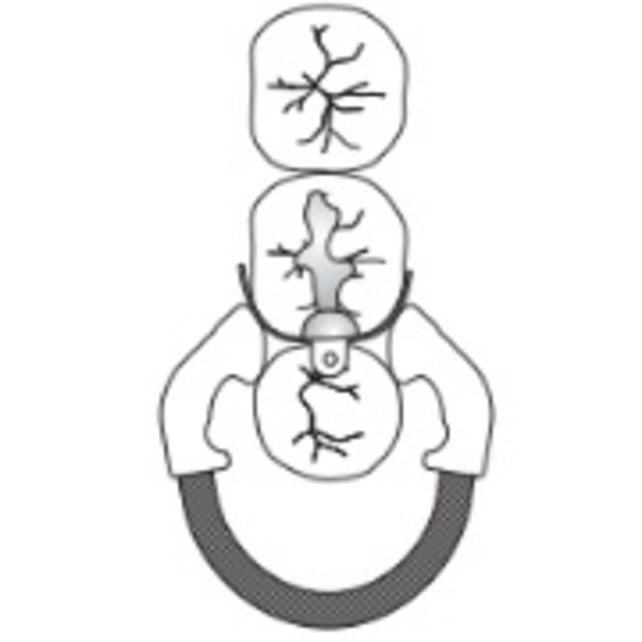 Palodent V3 / Plus - Use Case Mesial-Occlusal